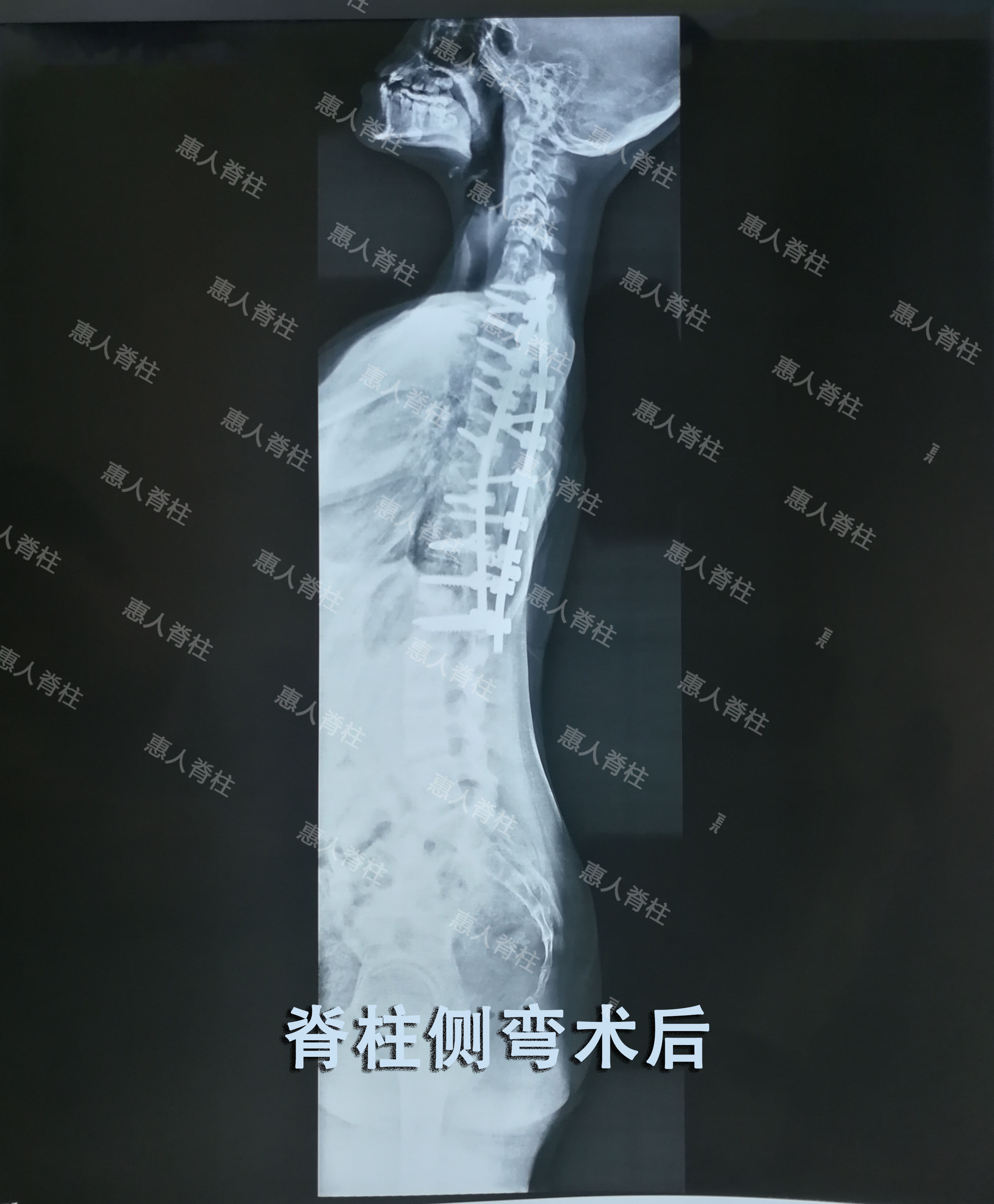 先天性脊柱侧凸是由于脊柱在胚胎时期出现脊椎的分节不完全,一侧有骨