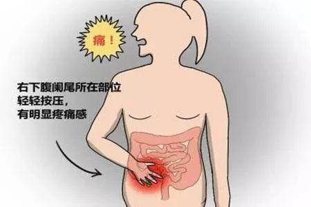 可出现右下腹皮肤感觉过敏现象,它并不因阑尾位置不同而改变,如阑尾