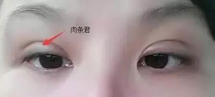 什么是双眼皮肉条感 49b07b90950546fbbe1b39ff8a73d580.jpeg