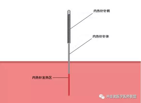 内热针技术治疗疾病的原理是什么