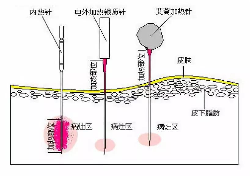 花椒水治打呼噜的原理_花椒泡水能治打鼾吗