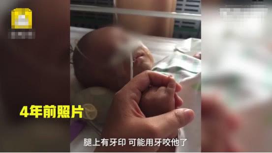                     男婴被亲爸打成脑积水，还不准母亲送他去医院，孩子至今不会说话