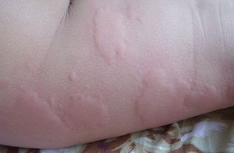 小儿荨麻疹,俗称风疹团,是一种常见的过敏性皮肤病.
