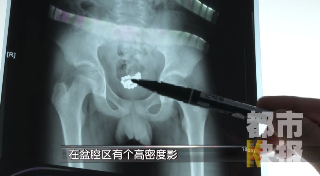                     @所有家长,此物极其危险!13岁男孩竟将它塞进下体憋了三个月,路都走不了