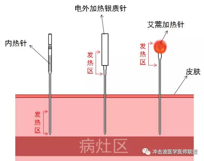 内热针技术治疗疾病的原理是什么