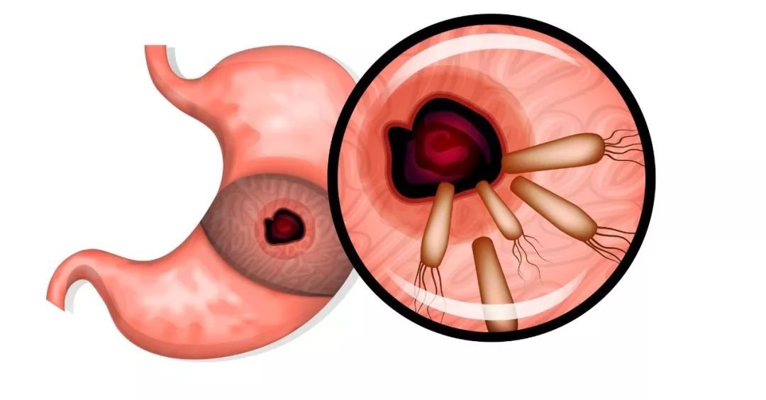 中国一半人口感染胃癌细菌_胃癌手术伤口感染病人