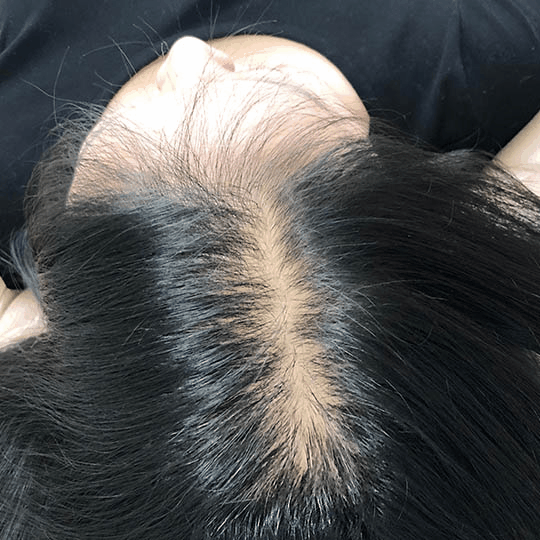 “秃”然袭击！超5成大学生有脱发困扰 秃如其来的1000亿大市场！