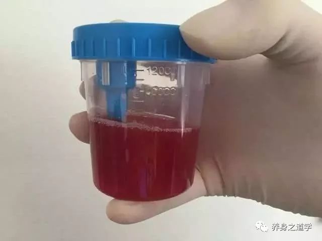 什么情况下会有血尿 fceebe02c9c44880b434e102ce7b531b.jpeg