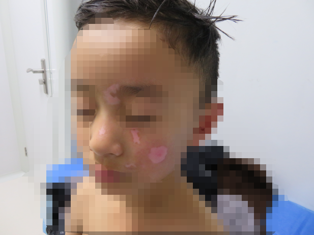 7岁孩面部白斑初次来院照片.