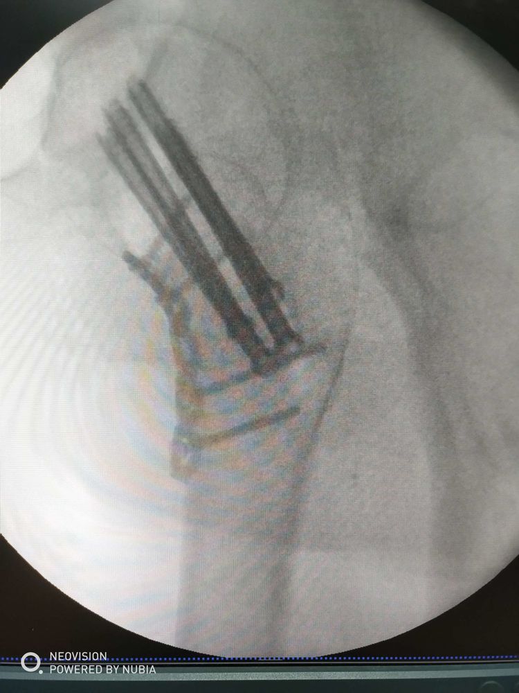 陕西中医药大学附属医院一例剪切型股骨颈骨折病例分享