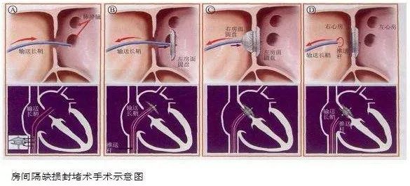 经彩色多普勒超声引导行房间隔缺损介入封堵术,其具有分辨率高,无X线