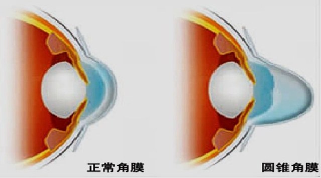 圆锥角膜镜在验配的时候碰到这些常见问题,你