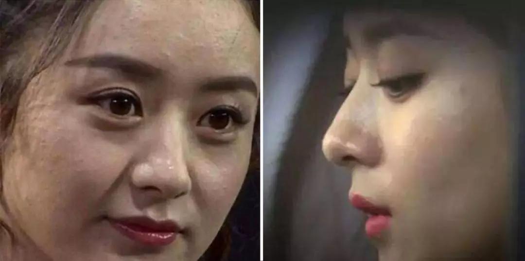 油皮小公举赵丽颖也是很好的例子,有段时间她脸部大面积爆痘,迷之粗糙