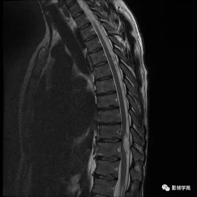 髓外硬膜下肿瘤影像学解析_神经