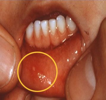 口腔症状 3 手足口病诊病三招 一看发出来的红疹具体在什么部位,只有