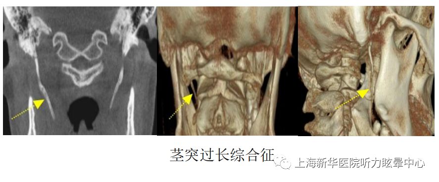 颈部疾病  如茎突过长综合征.