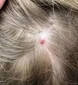                     1个月内已致3人死亡！宝宝被这种虫叮咬后，千万别用手拍！