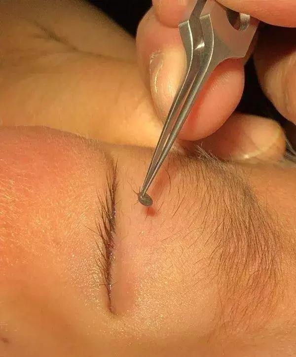 警惕!宝宝身上突然出现这样的小黑点,原来不是虫子叮咬