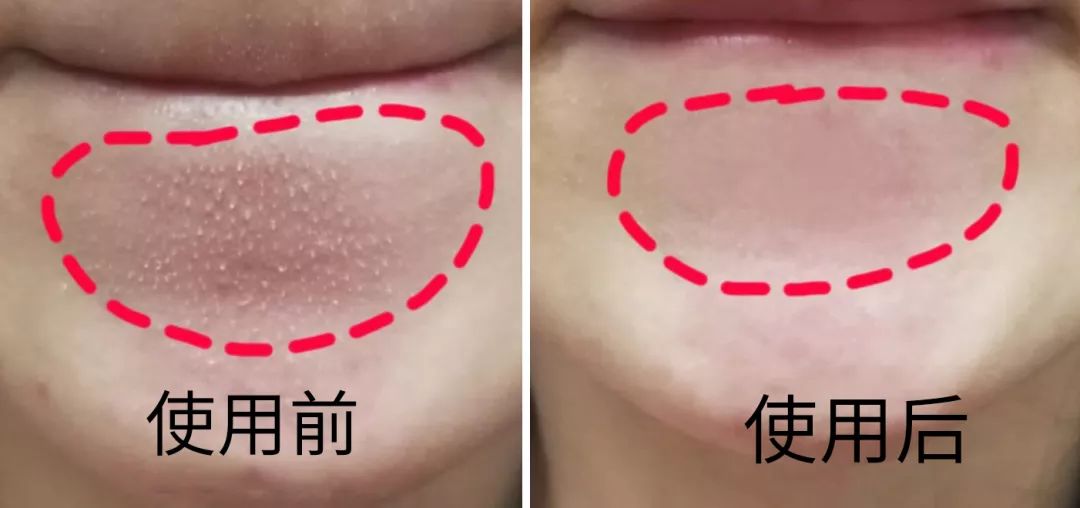 $69元 扫码购买 5 额头闭口,下巴粉刺 都来敷一敷 额头上的粉刺白头也