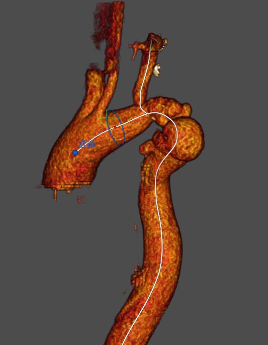 病例分享吉林大学白求恩第一医院心脏外科运用castor03分支型主动脉