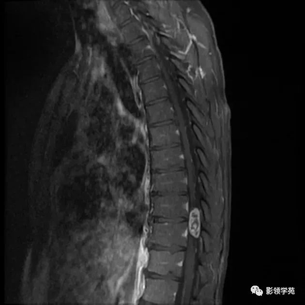 髓外硬膜下肿瘤影像学解析_神经