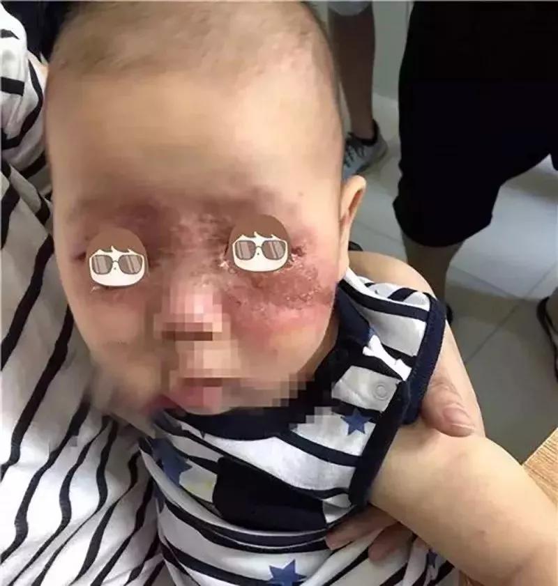                     1个月内已致3人死亡！宝宝被这种虫叮咬后，千万别用手拍！