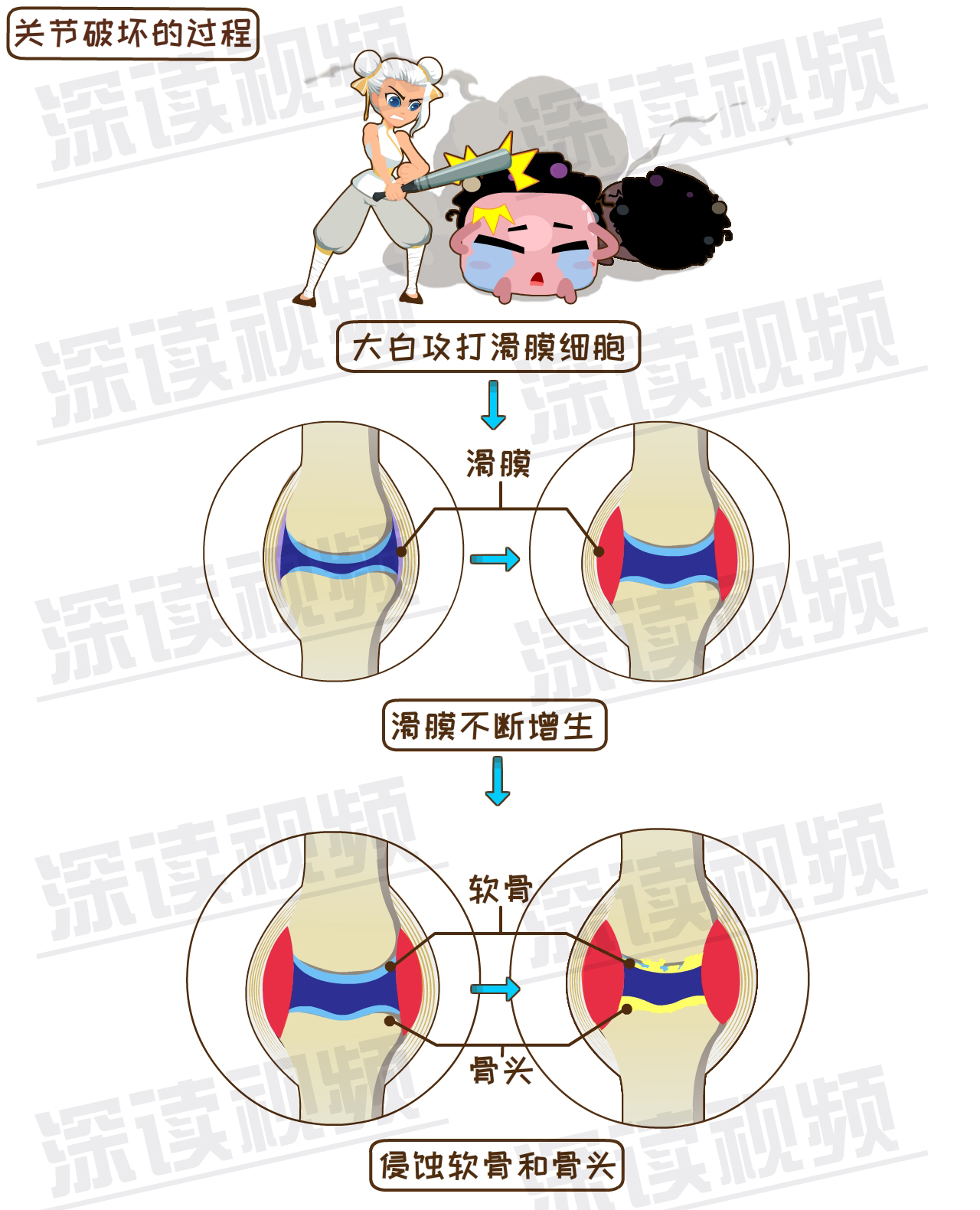 解密类风湿关节炎发病机制