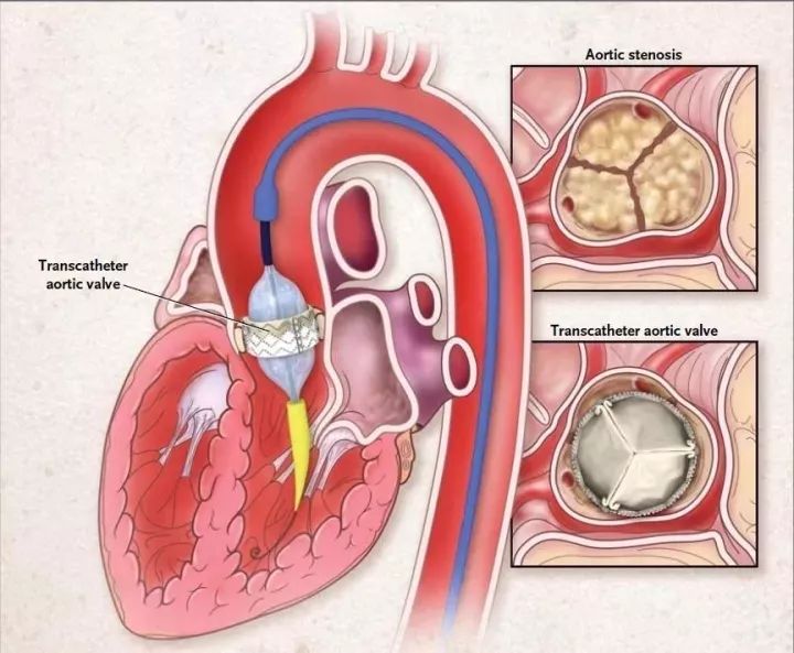 不开胸恢复快tavr不再是高危主动脉瓣狭窄患者的专利