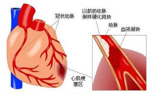 金秋健康科普三分钟教您读懂心肌梗死