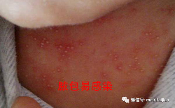                     原创            夏季宝宝长疙瘩，妈妈请分清（看图），注意这些都不是婴儿湿疹