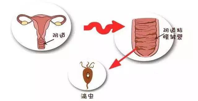 阴道里长了虫滴虫性阴道炎该如何治含联合用药