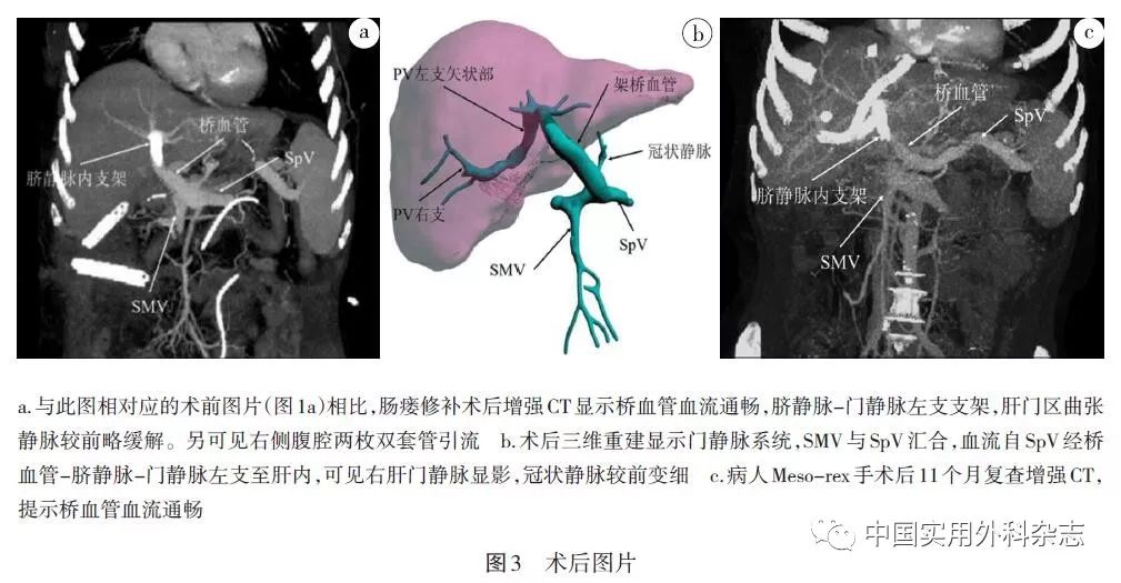 论著脐静脉再通联合一期支架植入法改良mesorex手术治疗门静脉海绵样