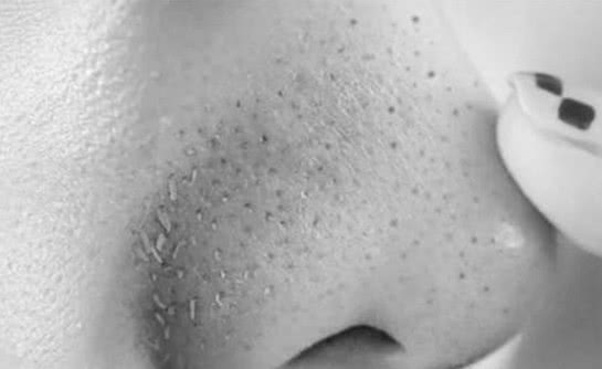 3条坑人的去黑头建议,8成人被害,变黑芝麻鼻