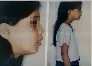                     孩子越长越“丑”？可能是这个原因！