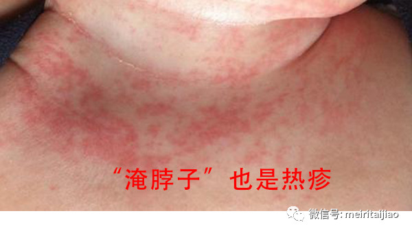                     原创            夏季宝宝长疙瘩，妈妈请分清（看图），注意这些都不是婴儿湿疹