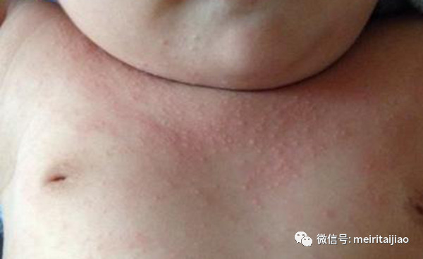                     原创            夏季宝宝长疙瘩，妈妈请分清（看图），注意这些都不是婴儿湿疹