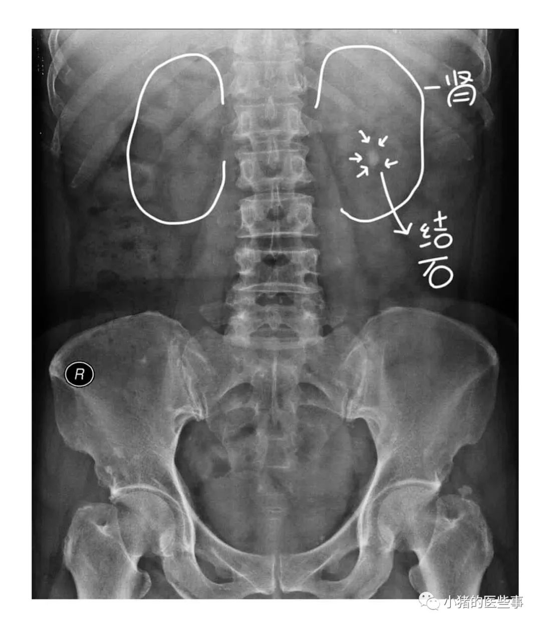 肾结石x线图片_39健康网_精编内容