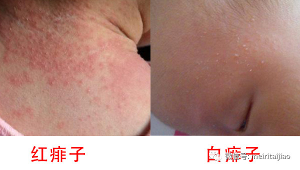                     原创            夏季宝宝长疙瘩，妈妈请分清（看图），注意这些都不是婴儿湿疹