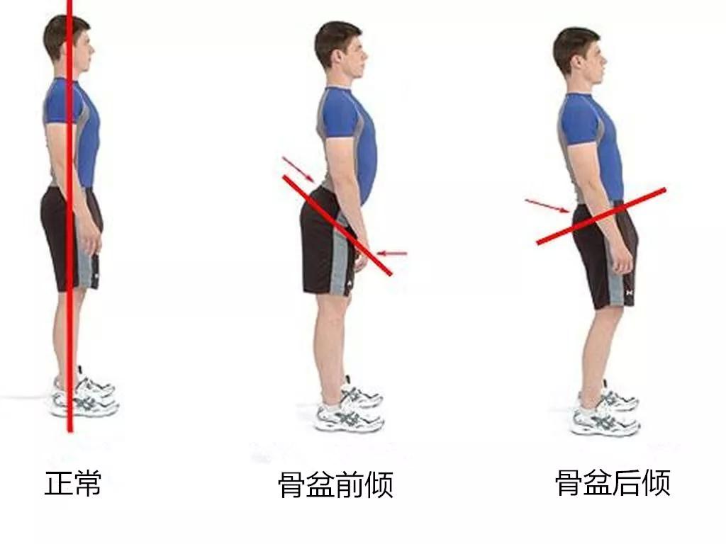 骨盆前倾危害大不如试试这个3个小动作帮你缓解