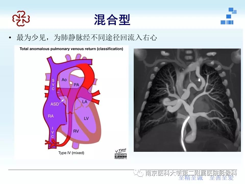 精彩推荐 肺静脉异位引流影像表现