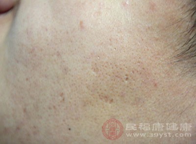 吃什么可以减少皮脂腺油脂分泌过多 a5f60e4be6c34e43a38e7de6edaf9945.jpeg