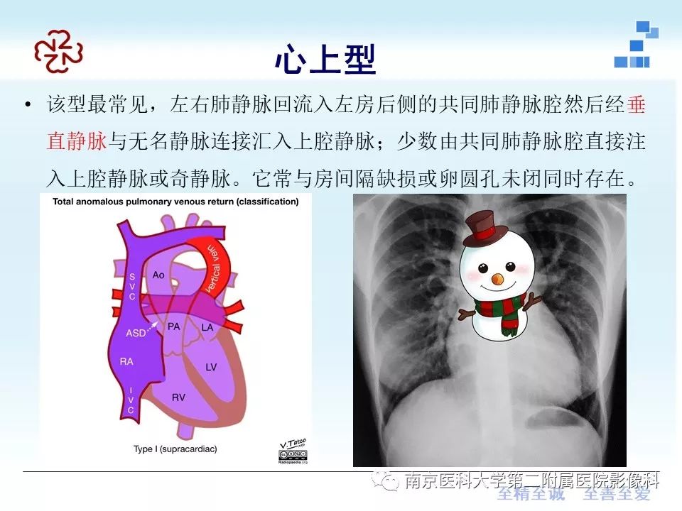 精彩推荐 肺静脉异位引流影像表现