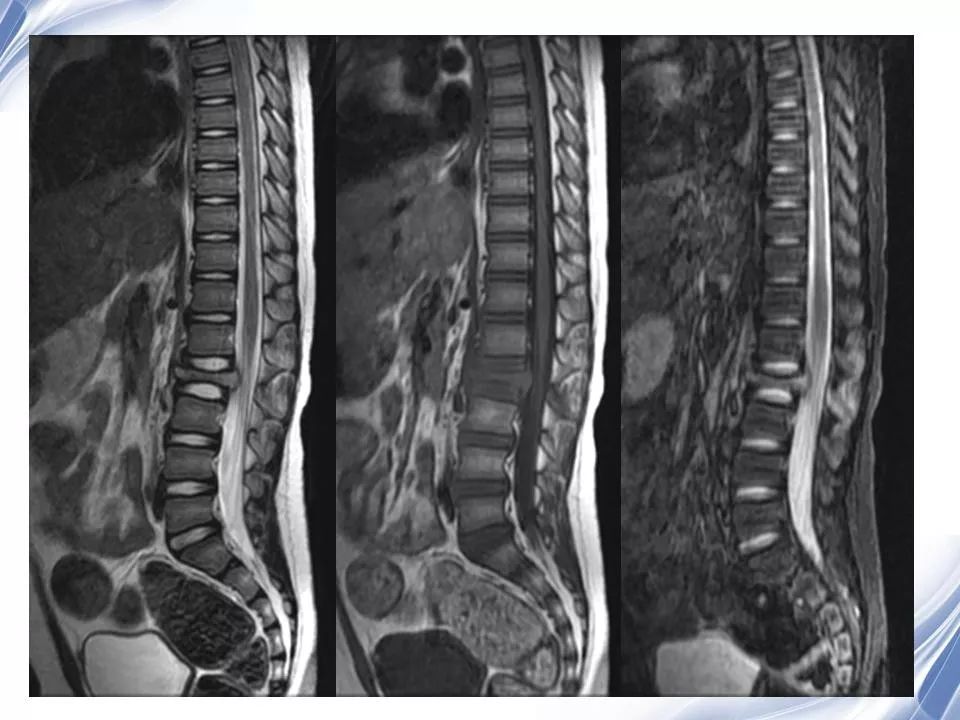 脊柱原发性恶性淋巴瘤的影像诊断 | 影像天地