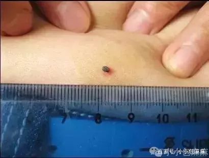                     1月之内3人身亡，宝宝身上出现这种“小黑痣”别大意！