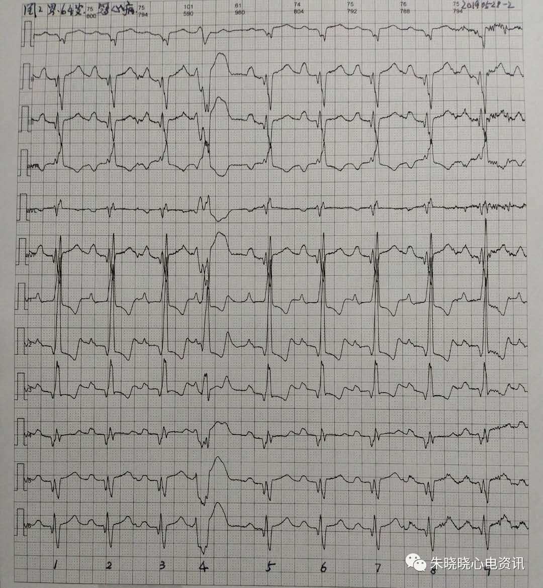 卢老师看心电图交界性早搏2019528