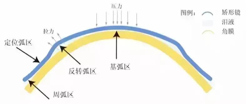 塑形镜的原理_△角膜塑形镜视力矫正原理