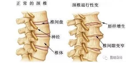 颈椎骨质增生就是颈椎病吗?