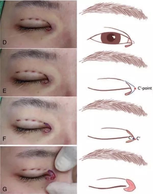 回旋镖式内眦赘皮矫正术让倒l法成为过去式