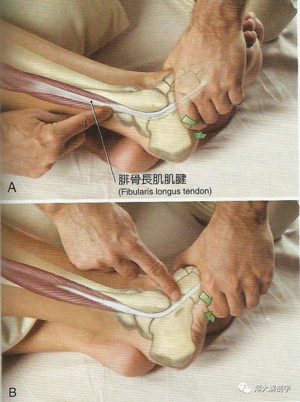 腓骨长肌肌腱经常可在邻近外踝近端处看到当患者抵抗阻力将足部外翻
