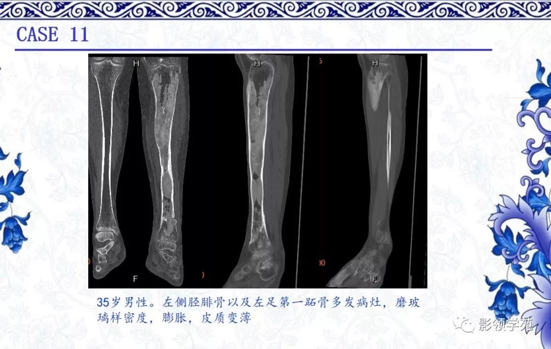 层骨)构成纤维组织主要由温和的成纤维细胞构成由纤维和骨性组织构成